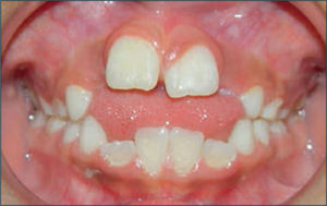 Paciente con interposición de lengua que muestra la mordida abierta anterior con la lengua interpuesta entre incisivos definitivos superiores e inferiores.