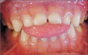 Paciente con interposición lingual en dentición temporal que muestra mordida abierta anterior, falta de entrecruzamiento entre los dientes superiores e inferiores, e interposición lingual en reposo y en deglución.