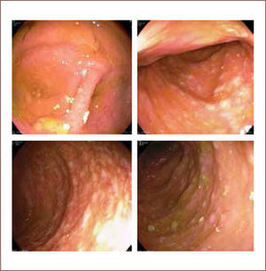 Colonoscopía donde se muestran lesiones en colon compatibles con una colitis pseudomebranosa