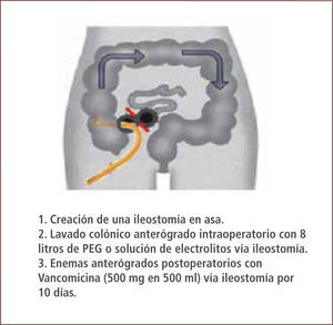 Ileostomía en asa vía laparoscópica