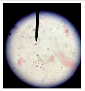 Microscopía directa con tinción de gram de líquido cerebroespinal