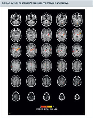 Resonancia magnética funcional con el registro de blood oxygen level-dependence (BOLD) en bloques de activación con estímulo de térmico de 50oC en el antebrazo derecho, con activación de la corteza somatosensitiva e insular contralateral. Asimismo se evidencia una activación del tálamo ipsi y contralateral. Estudio realizado en resonador GE 3 Teslas, Clínica Alemana en colaboración con el Sr. Francisco Zamorano (Centro de Investigación en Complejidad Social, UDD).