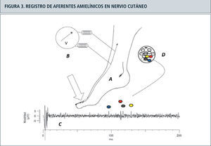 Registro de la actividad de axones no mielinizados desde un nervio cutáneo mediante un electrodo de tungsteno, insertado en forma percutánea en el nervio peroneo superficial de un individuo despierto (A). La señal es amplificada y digitalizas en B, para ser desplegada en un barrido de 0.2 segundos de duración como se ilustra en C. El estímulo eléctrico intradermal de baja intensidad en el campo receptivo de la piel (flecha) activa dos axones cercanos al electrodo activo, que se muestran en colores en una animación de un corte transversal del nervio (D). La latencia de las unidades corresponde a una velocidad de conducción de 0.83 y 0.92m/s, en el rango “C”.