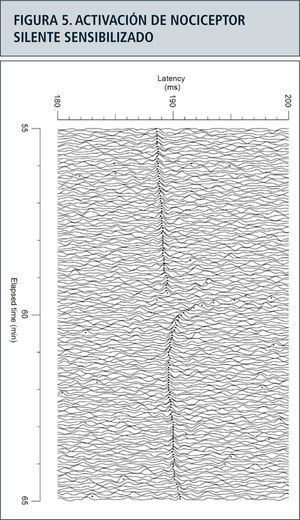 La figura ilustra un nociceptor silente con un campo receptivo en el dorso del pie izquierdo de un sujeto sano, activado por un estímulo eléctrico con frecuencia de 0.25Hz. Súbitamente incrementa la latencia de la respuesta en el minuto 59 del registro, como consecuencia del disparo espontáneo de un tren de potenciales de acción como consecuencia de la sensibilidad adquirida por la capsaicina, el ingrediente activo del ají.