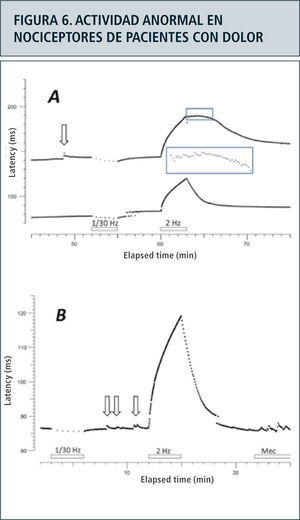 Campero y colaboradores, 2012. Revista Médica de Chile. Actividad espontánea en nociceptores polimodales y nociceptores silentes en pacientes con dolor neuropático asociado a polineuropatía de fibras delgadas con síntomas sensitivos positivos.