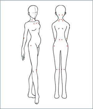 Distribución característica de los 18 puntos dolorosos en fibromialgia