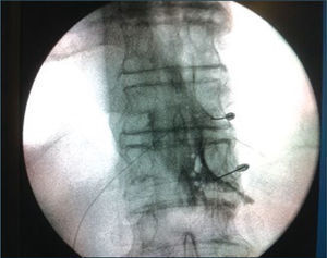 Radiofrecuencia del ganglio de raíz dorsal