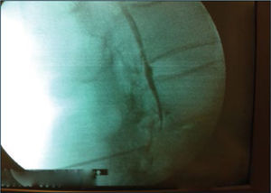 Epidural Interlaminar que muestra distribución del contraste en espacio epidural anterior