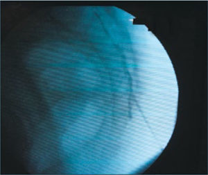 Epidural caudel