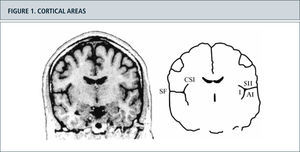 Figura 2. Cortical areas around the Sylvian fissure in the human brain. (Left) Magnetic resonance image of a coronal section through the brain of a healthy human subject. (Right) Schematic outlines of this section. The secondary somatosensory cortex (SII) is situated in the upper bank of the Sylvian fissure (SF). The primary auditory cortex (AI) is situated in the opposite, lower bank of the Sylvian fissure, in Heschl's transverse gyrus. On the medial side, SII is situated close to the insular cortex (I), which lies on the opposite bank of the circular sulcus of the insula (CSI). The cortex above the Sylvian fissure contains multiple somatosensory areas, the functions of which are largely unknown. Nociceptive areas in this region overlap only partly with tactile areas and the classical SII region. Nociceptive areas are also found in parts of the insular cortex. Cortical representation of pain: functional characterization of nociceptive areas near the lateral sulcus.