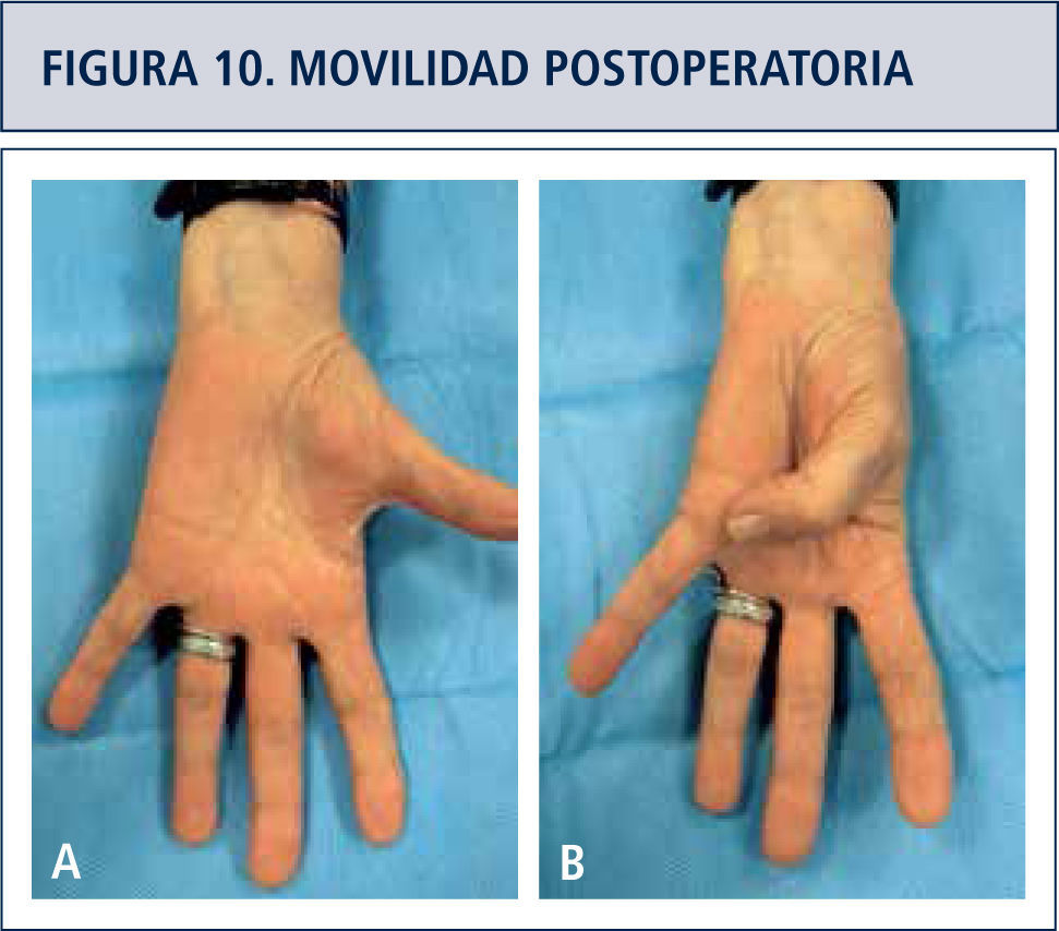 Artrosis en la mano  Revista Médica Clínica Las Condes