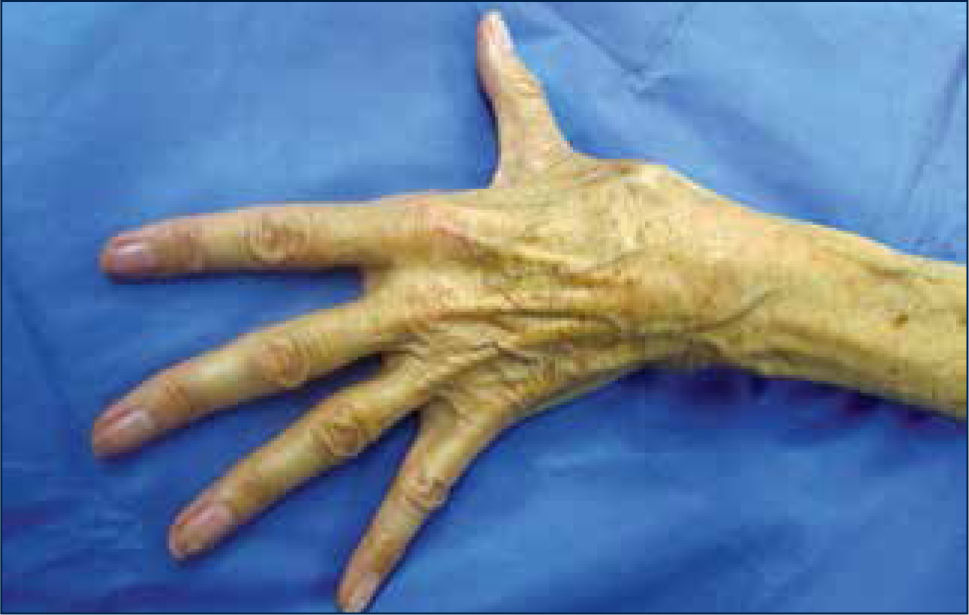 Artrosis en la mano  Revista Médica Clínica Las Condes