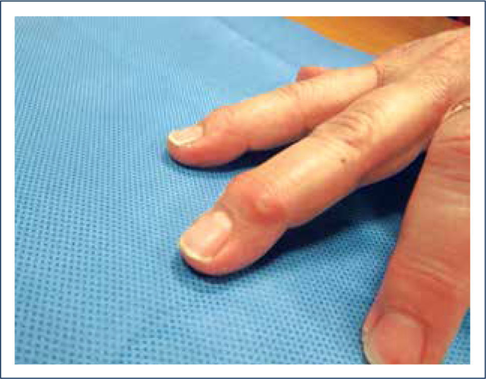 Artrosis de la mano - Osteoarthritis