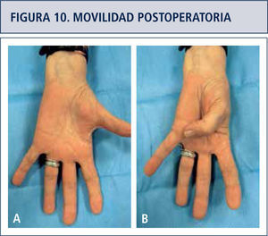 Movilidad post artroplastia. Abducción y aducción del pulgar.