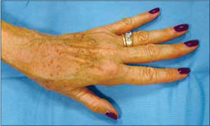 Artrosis de mano: ¿Cómo detectarla? - Clínica Las Condes