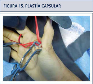 Plastía capsular para corregir la hiper-extensión metacarpofalángica.