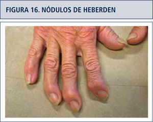Artrosis interfalángica distal en todos los dedos.