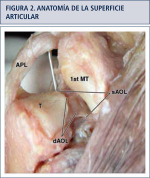 Detalle anatómico de las superficies articulares de la base del primer metacarpiano y aspecto distal del trapecio. Articulación en silla de montar. APL: Abductor Largo del Pulgar MT: Metacarpiano sAOL: Ligamento Oblicuo Anterior