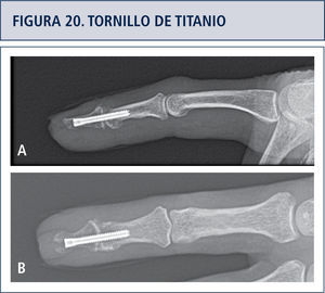 Figura a. Visión lateral. Figura b. Visión AP.