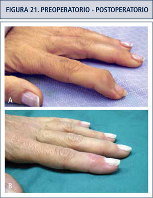 Figura a. Artrosis IFD dedo índice. Figura b. Aspecto post artrodeis.