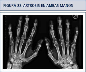 Severa artrosis en ambas manos que compromete las Interfalángica proximales y distales. Nótese que las metacarpo-falángica no tienen daño.