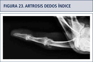 Artrosis severa IFD e IFP dedo índice.