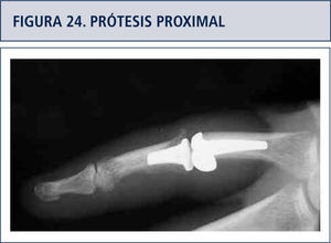 Prótesis interfalángica proximal.