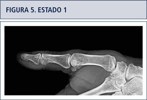 Disminución progresiva del espacio articular, luego una esclerosis del hueso sub-condral, más adelante erosión, osteofitos y sub-luxación articular.