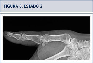Disminución progresiva del espacio articular, luego una esclerosis del hueso sub-condral, más adelante erosión, osteofitos y sub-luxación articular.