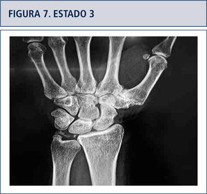Disminución progresiva del espacio articular, luego una esclerosis del hueso sub-condral, más adelante erosión, osteofitos y sub-luxación articular.