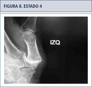 Disminución progresiva del espacio articular, luego una esclerosis del hueso sub-condral, más adelante erosión, osteofitos y sub-luxación articular.