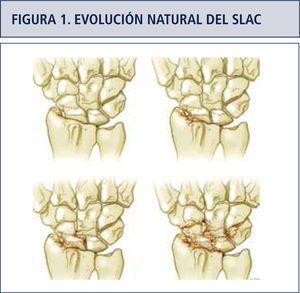 Evolución natural del SLAC o SNAC, Etapa I comenzando en el estiloides radial, Etapa II radioescafoídea, Etapa III mediocarpiana y Etapa IV panartrosis.