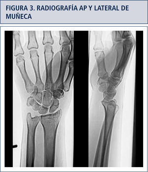 Rx. Anteroposterior y lateral de muñeca. Publicación autorizada por el paciente, a través del consentimiento informado.