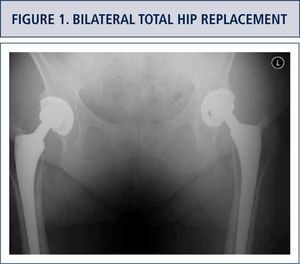 Twenty year followup pelvis radiograph in a 65 year old female with bilateral total hip replacements for moderate acetabular dysplasia and osteoarthritis. Her functional status bilaterally is excellent though the radiographs demonstrate moderate linear wear of her conventional polyethylene liners.