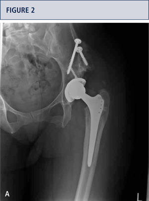Anteroposterior radiograph of a 35 year old female five years status post MOM total hip replacement for acetabular dysplasia and severe secondary osteoarthritis. She was initially pain free but now has diffuse left hip pain. MARS MRI image of her left hip demonstrates fluid collections posterior (large arrow) and anterior (small arrow) to left hip suggesting either infection or metal-on-metal local soft tissue reaction.