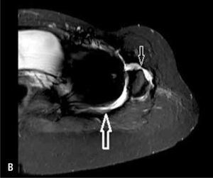 Anteroposterior radiograph of a 35 year old female five years status post MOM total hip replacement for acetabular dysplasia and severe secondary osteoarthritis. She was initially pain free but now has diffuse left hip pain. MARS MRI image of her left hip demonstrates fluid collections posterior (large arrow) and anterior (small arrow) to left hip suggesting either infection or metal-on-metal local soft tissue reaction.