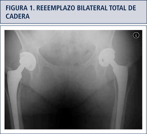 Radiografía de pelvis en un seguimiento a 20 años de una mujer de 65 años con reemplazo total de cadera bilateral por osteoartritis y displasia acetabular moderado. Su estado funcional bilateral es excelente aunque las radiografías indican un desgaste moderado de los forros de polietileno convencionales.