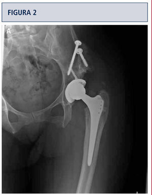 (A) Radiografía anteroposterior de una mujer de 35 años cinco años después de un reemplazo de cadera total con superficies de apoyo de metal sobre metal debido a displasia acetabular y osteoartritis secundaria severa. En un principio, no experimentó dolor pero actualmente sufre de dolor difuso en la cadera izquierda. (B) MARS imagen IRM de su cadera izquierda muestra acumulación de líquido posterior (flecha grande) y anterior (flecha chica) a la cadera izquierda lo cual sugiere una infección o reacción local de los tejidos blandos al metal sobre metal.