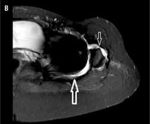(A) Radiografía anteroposterior de una mujer de 35 años cinco años después de un reemplazo de cadera total con superficies de apoyo de metal sobre metal debido a displasia acetabular y osteoartritis secundaria severa. En un principio, no experimentó dolor pero actualmente sufre de dolor difuso en la cadera izquierda. (B) MARS imagen IRM de su cadera izquierda muestra acumulación de líquido posterior (flecha grande) y anterior (flecha chica) a la cadera izquierda lo cual sugiere una infección o reacción local de los tejidos blandos al metal sobre metal.