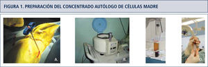 Preparación del Concentrado Autólogo de Células Madre: A. Toma de médula ósea de la cresta ilíaca, mediante trócar de punción. B. Proceso de centrifugación de la muestra. C. Muestra postcentrifugado en la cual se separan las células en base a un filtro de gradientes de densidad. D. Concentrado autólogo de células madre listo para ser aplicado.