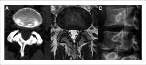 Imagen ología articulación face taria A: Tomografía Axial Computada B: Resonancia Magnética C: Radiografía oblicuas
