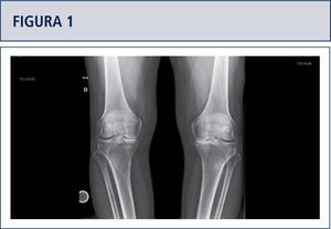 Genu Varo bilateral de rodilla correspondiente a una artrosis grado 4 de Kelgreen and Laurence de predominio medial subsidiaria de un reemplazo protésico unicompartamental.