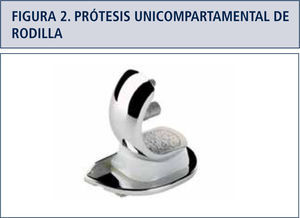 Componente esférico condilar femoral, platillo tibial plano y componente móvil de polietileno de alta densidad de alta congruencia.