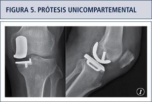 Prótesis unicompartemental oxford Knee medial 10 años de seguimiento postoperatorio.
