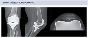 Prótesis total de rodilla PS 12 años de seguimiento postoperatorio. Resultado funcional exelente Pauta evaluación HSS.