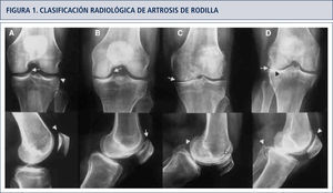 Clasificación radiológica de artrosis de rodilla según kellgren-lawrence.