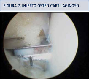 Instalación en la zona de lesión del auto injerto osteo cartilaginoso en forma de tarugo.
