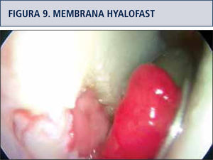 Colocación endoscópica de membrana maleable Hyalofast.