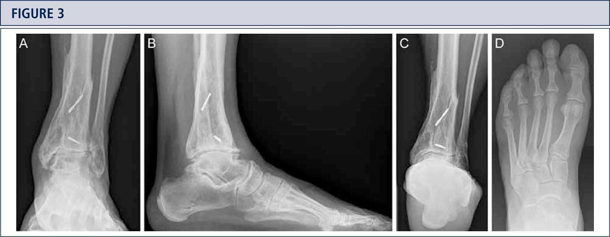 Xray Image Ankle Lateral View Show Stock Photo 272065442 | Shutterstock
