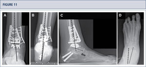 Five years after surgery, the patient was highiysatisfied with the result. Standard X-rays show a well-balanced ankle and stable implants. A) AP-view of the ankle showing a balanced talus within the ankle mortise; B) Saltzman alignment viewshowing a well aligned ankle joint complex; C), lateral view of the foot showing thea normalized position of talus (plantar flexión with overlapping of calcaneus of 20%); D) AP-view of the foot showing a normalized position of talus (talo-calcaneal angle of 28°).
